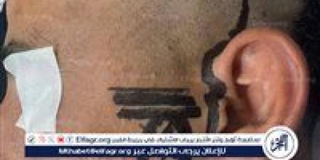 نتيجة اندماج العظام والأنسجة.. جراحة دقيقة وغير مسبوقة لشاب بمستشفى العامرية في الإسكندرية - الهلال الإخباري