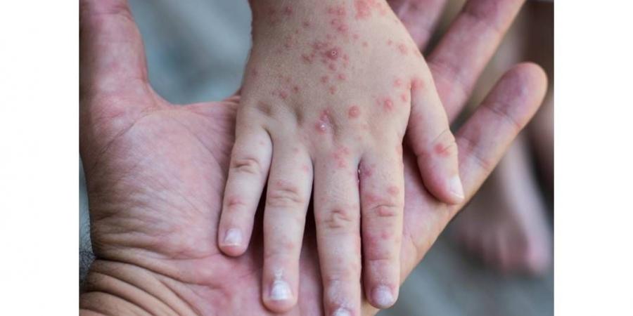 تكساس الأمريكية تسجل إصابات  جديدة بالحصبة - الهلال الإخباري