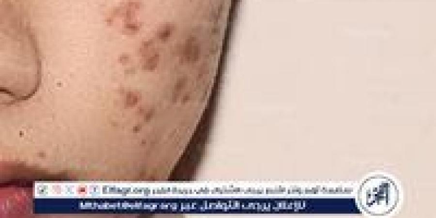 كيفية التخلص من آثار الحبوب.. مشكلة تؤرق الكثيرين - الهلال الإخباري